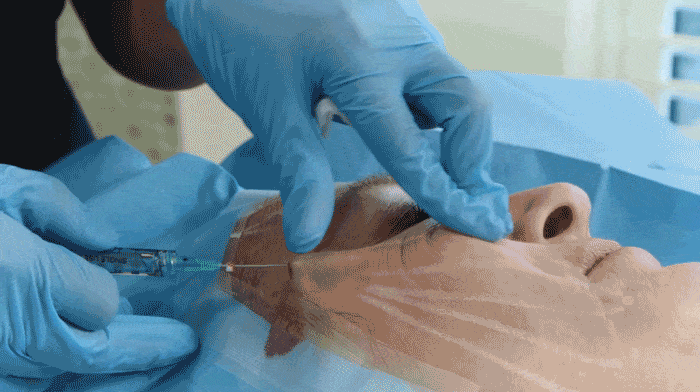 لیفتینگ صورت - لیفت با نخ، هایفوتراپی یا ژل الانسه